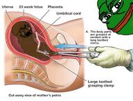 abortion amphibian animal arm black_skin bloodshot_eyes crying fetal_position fetus frog full_body glasses glove green_skin hand leg nas:pepe niglet open_mouth pepe pepe_the_frog soyjak stubble thick_eyebrows total_nigger_death variant:cryboy_soyjak // 788x600 // 495.6KB