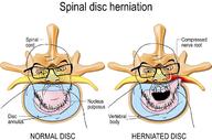 2soyjaks closed_mouth diagram frown glasses herniated_disc open_mouth soyjak spine stubble text variant:feraljak // 2100x1392 // 565.5KB