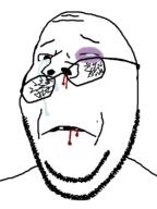 beaten black_eye blood broken_glasses bruise crying glasses soyjak stubble subvariant:wholesome_soyjak variant:gapejak // 600x800 // 44.0KB