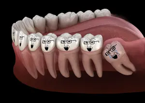 WisdomTooth.png