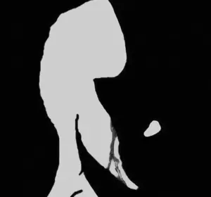 wojak, bald, covered eyes, depressed, mouth covered, no beard, ominous, portrait, skinny, three-quarter view