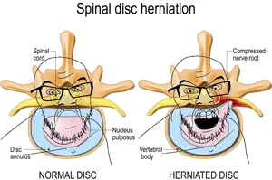 feraljak, 2soyjaks, closed mouth, diagram, frown, glasses, herniated disc, open mouth, soyjak, spine